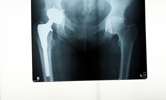 hip replacement