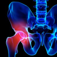 Wright Medical Pays $90 Million to Settle Remaining Hip Lawsuits