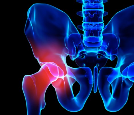 Wright Medical Pays $90 Million to Settle Remaining Hip Lawsuits